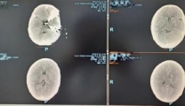 健康科普大篷车丨心脏骤停人生并非只能画上句号  看重症高压氧治疗如何涅槃重生 